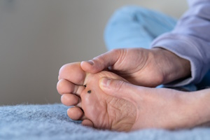 Бородавки и папилломы