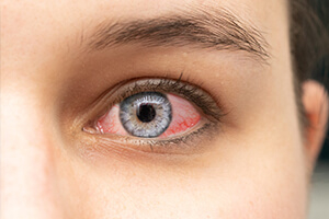 Конъюнктивит