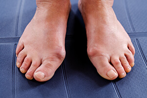 Косточка на ноге (вальгусная деформация)