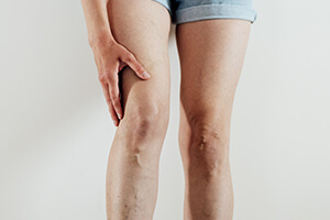 Варикозное расширение вен (варикоз)