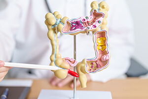 Синдром раздраженного кишечника (СРК)