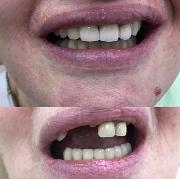 Стома Нева, фото №1